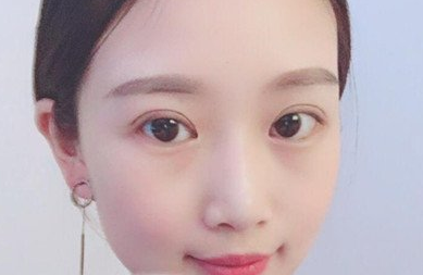 中下面部提升案例